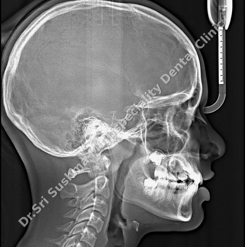 A lateral cephalogram: a side-view X-ray of the skull, jaws, teeth and face profile