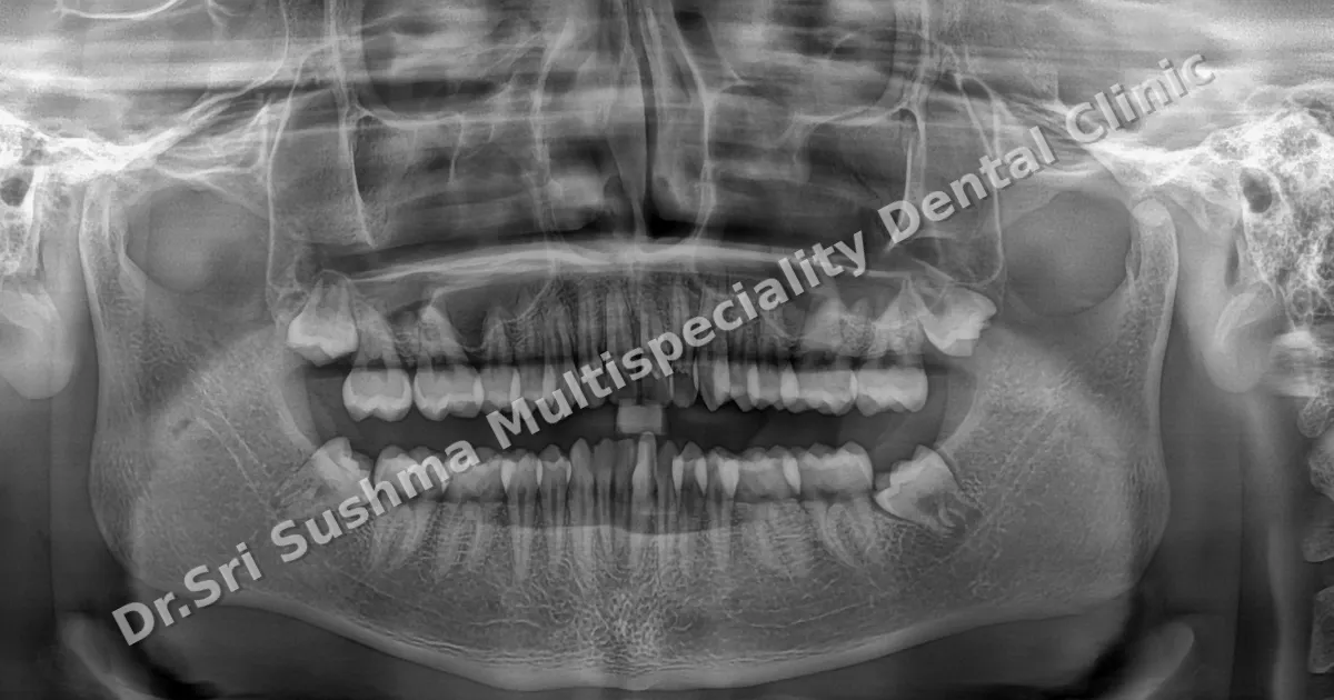 A panoramic (OPG) dental X-ray showing all the teeth, both jaws and the jaw joints