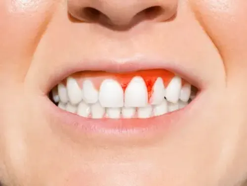 Stages of gum disease and periodontitis treatment in Hyderabad — Dr. Sri Sushma Dental Clinic Anandbagh