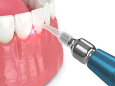 Laser Dental Treatment at Dr. Sri Sushma Multispeciality Dental Clinic, Anandbagh Hyderabad