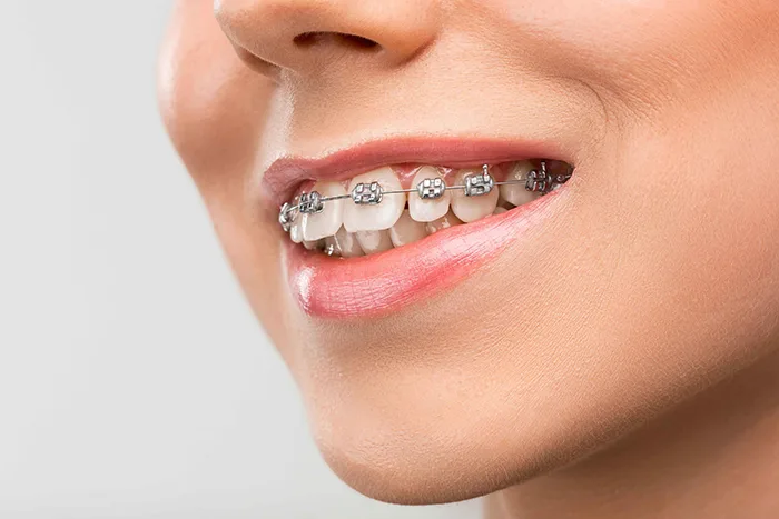 Braces cost guide Hyderabad 2026 — metal, ceramic and lingual braces prices at Dr. Sri Sushma Dental Clinic Anandbagh