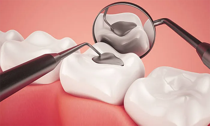 Dental Fillings at Dr. Sri Sushma Multispeciality Dental Clinic, Anandbagh Hyderabad