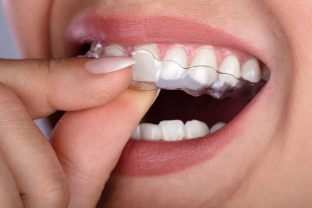 Clear Aligners in Hyderabad at Dr. Sri Sushma Multispeciality Dental Clinic, Anandbagh Hyderabad