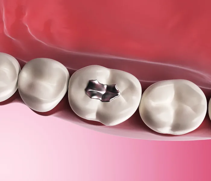 Dental Fillings in Hyderabad at Dr. Sri Sushma Multispeciality Dental Clinic, Anandbagh Hyderabad