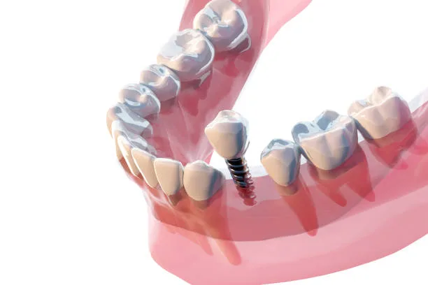 Dental Implants in Hyderabad at Dr. Sri Sushma Multispeciality Dental Clinic, Anandbagh Hyderabad