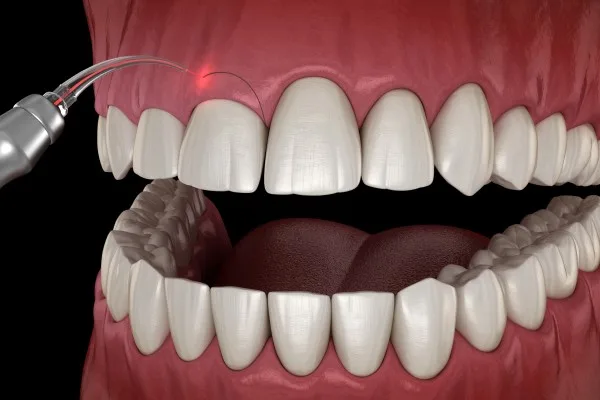 Laser Dental Treatment in Hyderabad at Dr. Sri Sushma Multispeciality Dental Clinic, Anandbagh Hyderabad