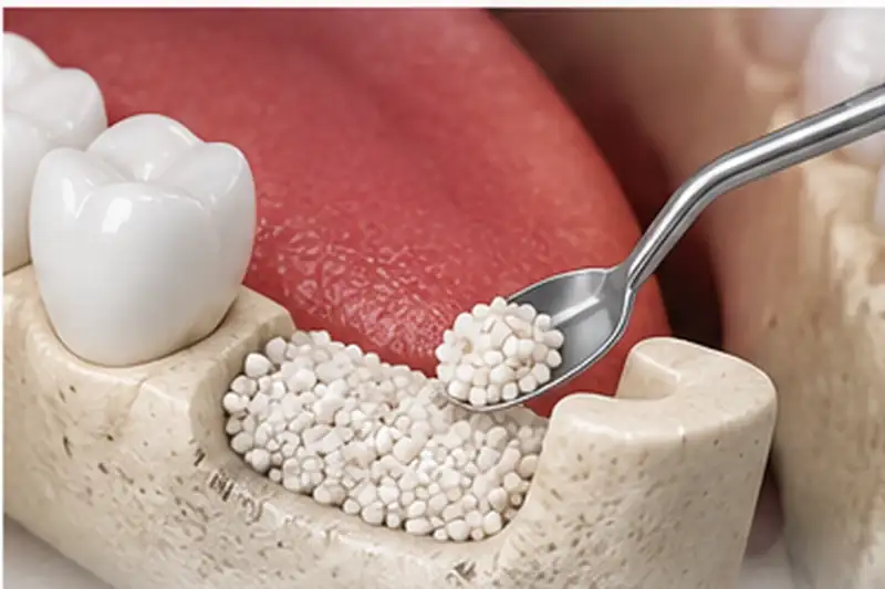 Dental Bone Grafting at Dr. Sri Sushma Multispeciality Dental Clinic, Anandbagh Hyderabad