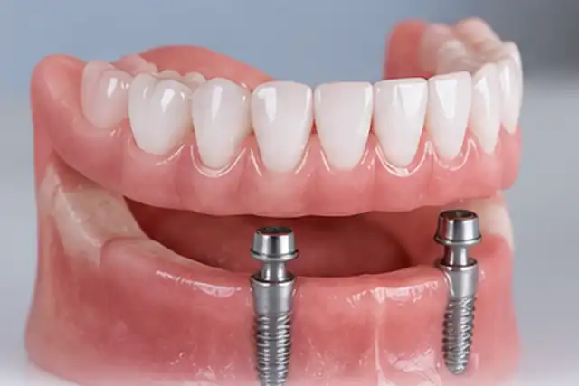 Implant-Supported Dentures in Hyderabad at Dr. Sri Sushma Multispeciality Dental Clinic, Anandbagh Hyderabad