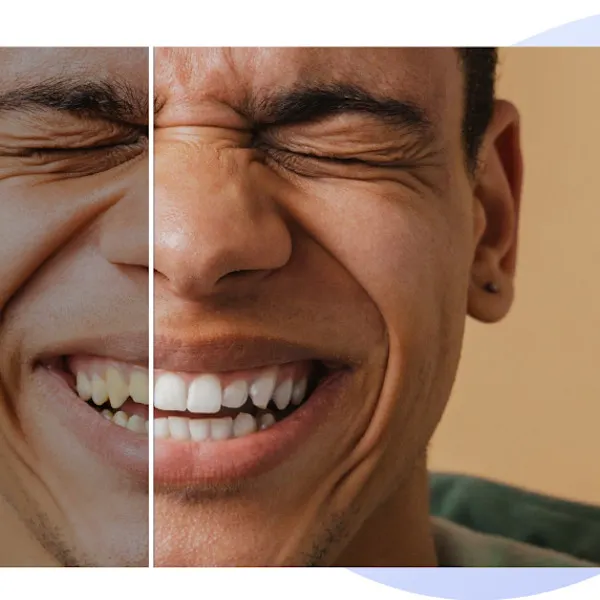 Smile Makeover at Dr. Sri Sushma Multispeciality Dental Clinic, Anandbagh Hyderabad