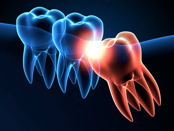 Tooth Extraction at Dr. Sri Sushma Multispeciality Dental Clinic, Anandbagh Hyderabad