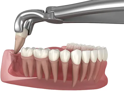 Wisdom Tooth Removal at Dr. Sri Sushma Multispeciality Dental Clinic, Anandbagh Hyderabad