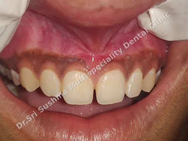 After: The same area after the frenum was removed and the gum healed