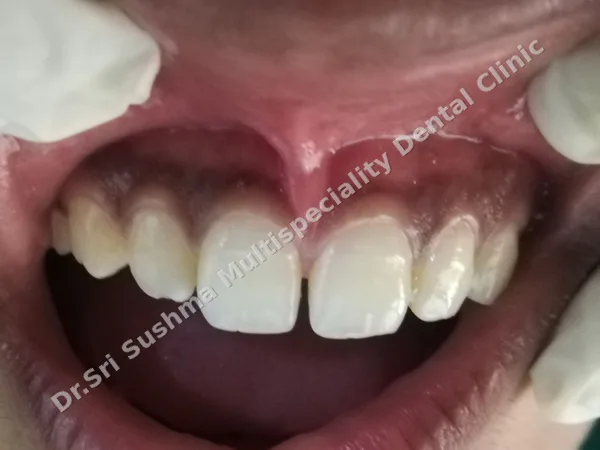 Before: Upper lip lifted to show a frenum attached low between the upper front teeth
