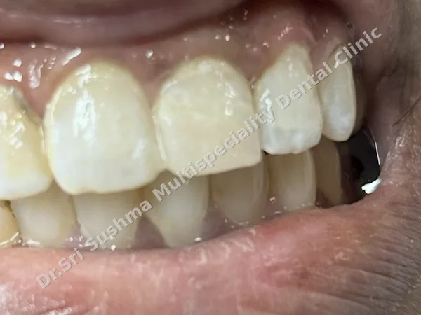 After: The same front teeth after the broken tooth was restored