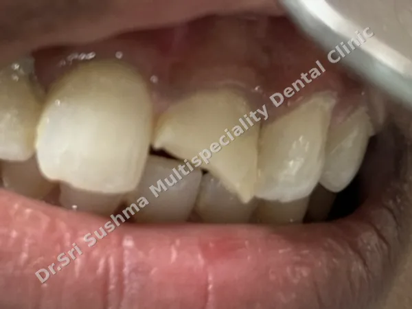 Before: Upper front teeth with one front tooth broken