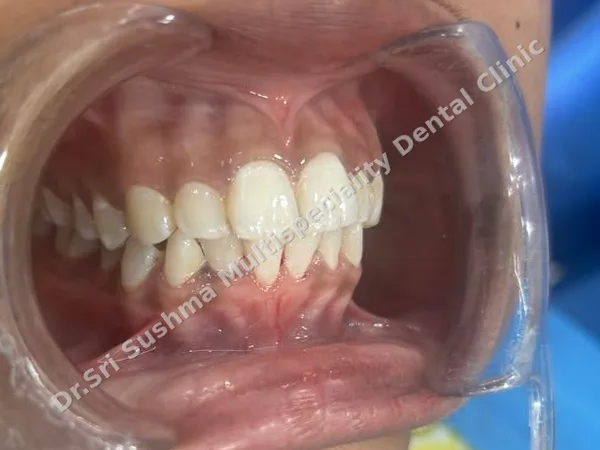 After: The same front teeth after scaling, with the tartar and stains removed