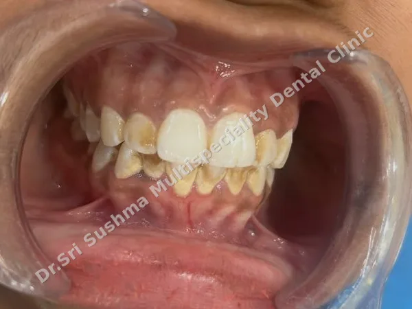 Before: Front teeth with yellow-brown tartar and stains along the gums, before scaling